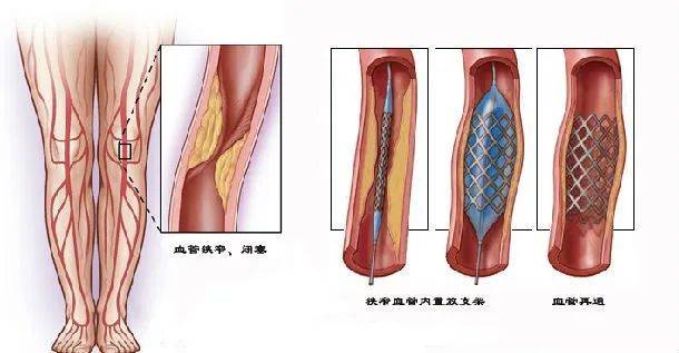 静脉血栓一般怎么治疗？看到的人都很幸运！哈尔滨微创深静脉血栓
