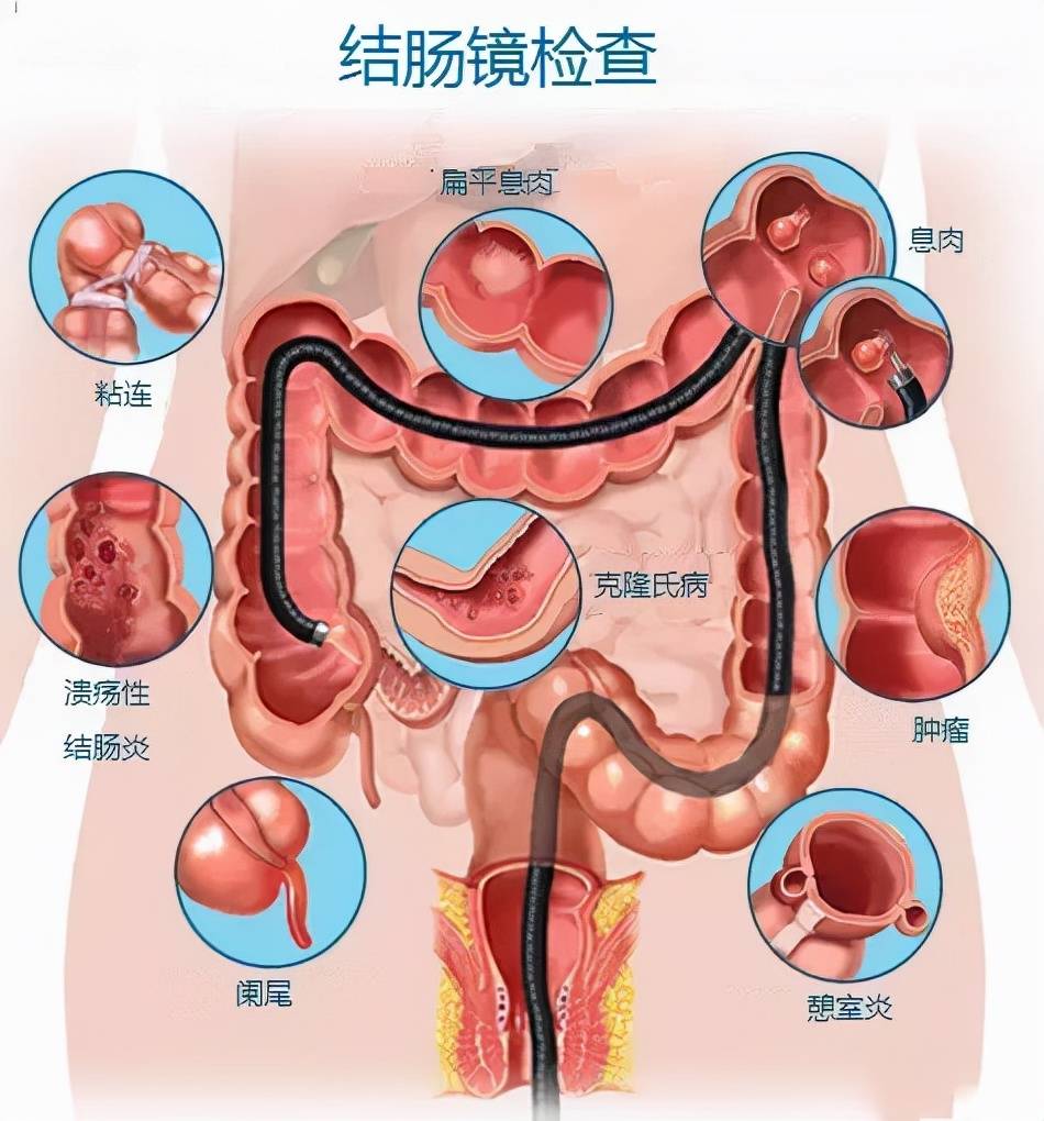 肠镜一般几年做一次？哈尔滨肠镜哪家医院好