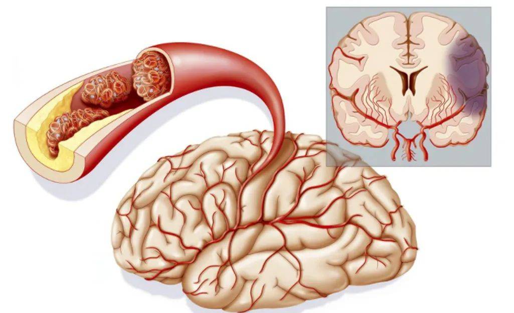 老年人大脑血管堵塞怎么办哈尔滨脑血栓哪家医院好