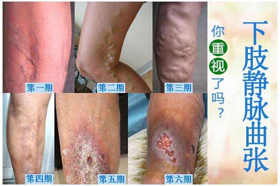 老烂腿如何治疗效果好？日常应该注意什么哈尔滨看病静脉曲张去哪