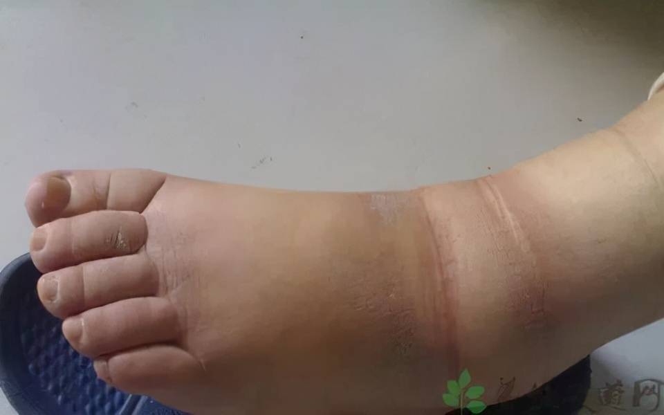 小腿浮肿一按一个坑怎么消除哈尔滨治疗静脉血栓哪家医院好