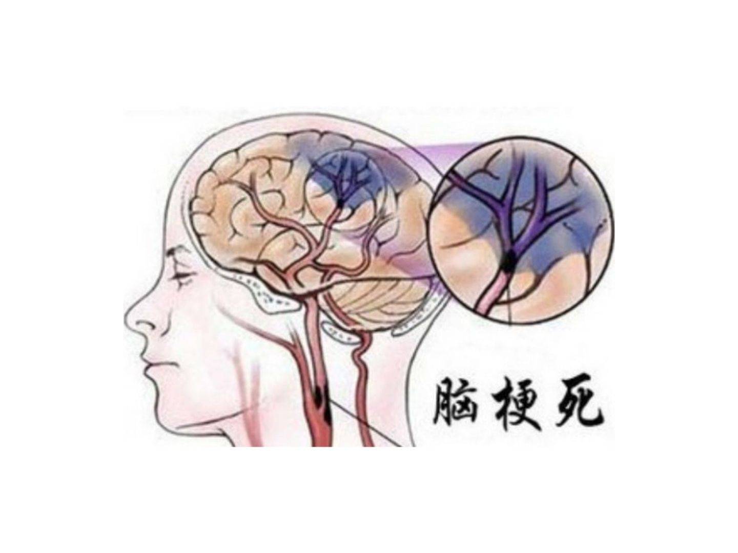 脑梗塞是什么引起的？发病征兆有哪些？发病时如何应对？哈尔滨看脑梗哪家正规