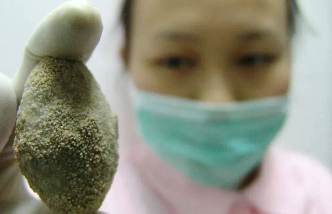 [前十医院]胆囊多发息肉样病变严重吗？哈尔滨胆结石手术,哈尔滨胆囊结石手术医院