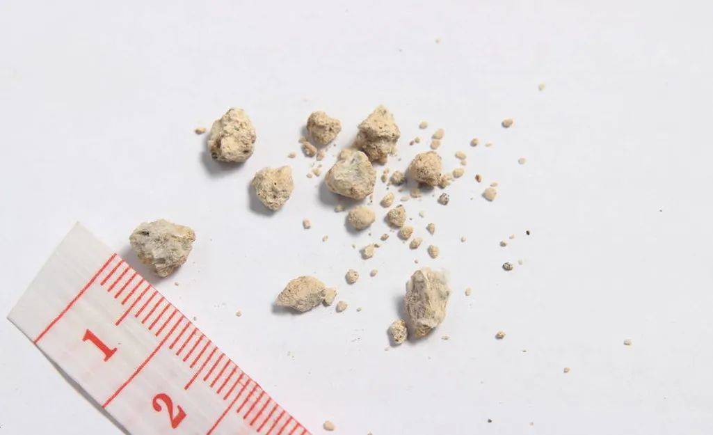 胆结石会引发哪些症状？你一定要清楚哈尔滨结石医院