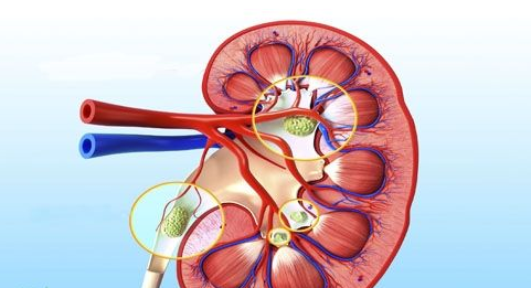 肾脏结石排除的方法哈尔滨治疗肾脏结石医院