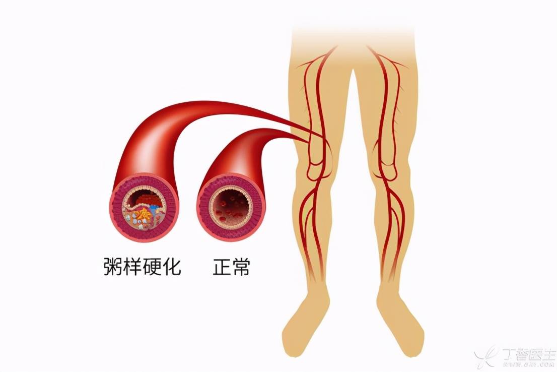 下肢动脉硬化闭塞症治疗方案哈尔滨查下肢动脉硬化闭塞症好医院