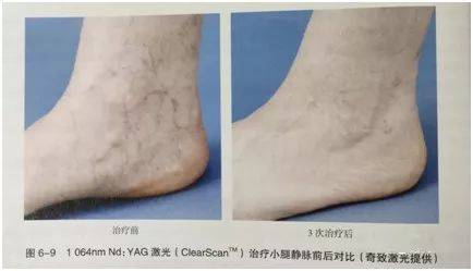 脚烂是什么原因哈尔滨治糖尿病足哪个医院好