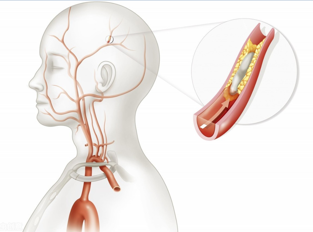 颈部动脉斑块治疗方式有哪些？哈尔滨颈动脉斑块谁治的好些