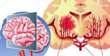 脑出血后遗症抽搐怎么办哈尔滨治脑出血的好医院