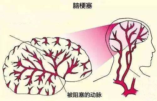 看脑梗哈尔滨去哪家医院好