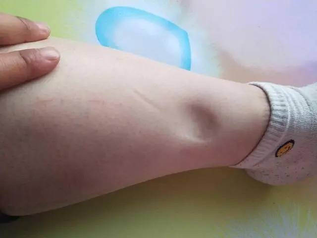 下肢动脉闭塞一般手术多少钱？哈尔滨一大二院静脉血栓袜