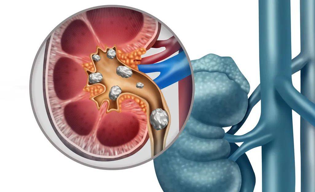 肾结石原因及症状哈尔滨哪家医院治肾结石好