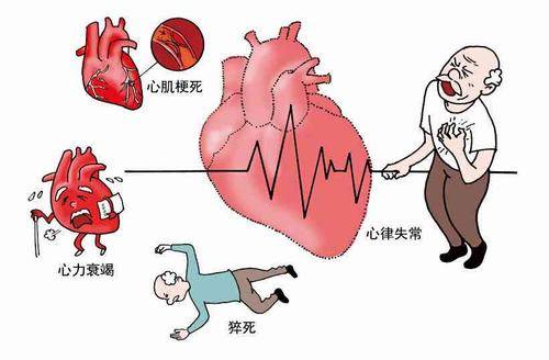 急性心梗症状前兆是什么？冠心病 哈尔滨 医院