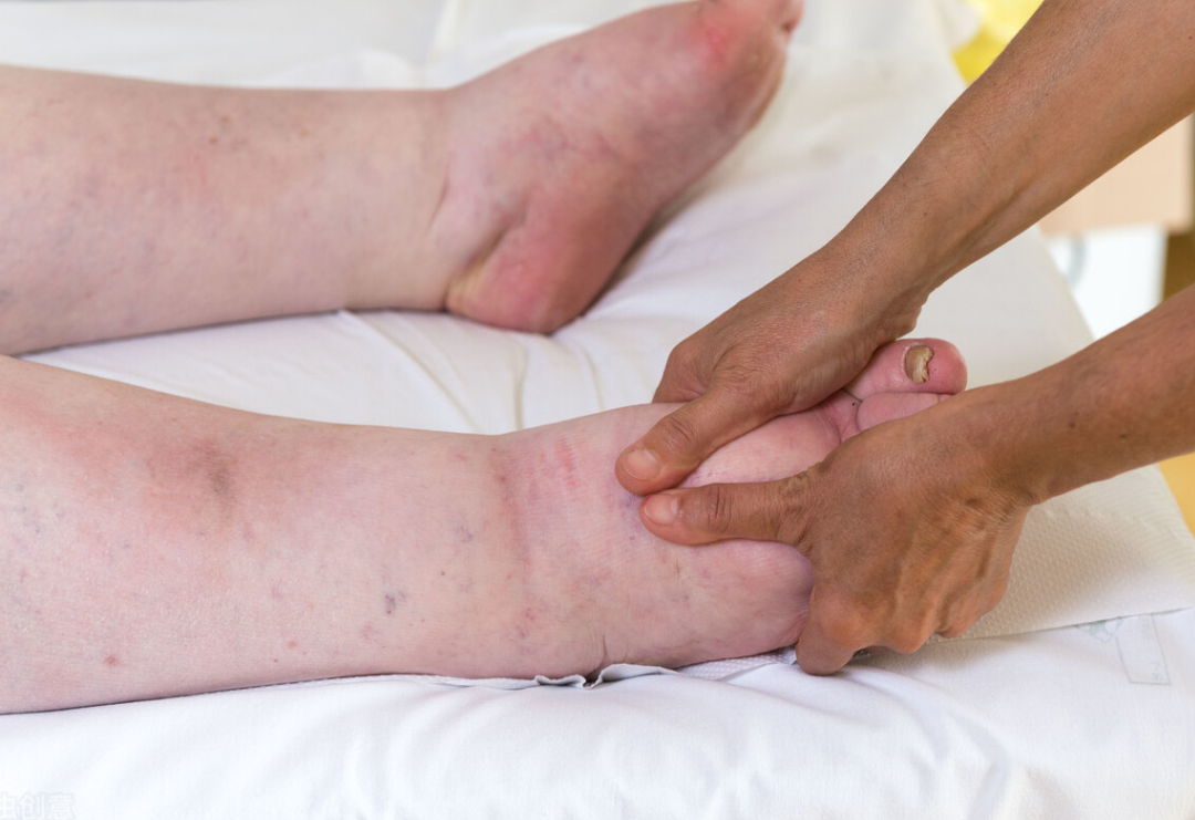 腿肿脚肿是什么原因引起的？哈尔滨静脉血栓治疗