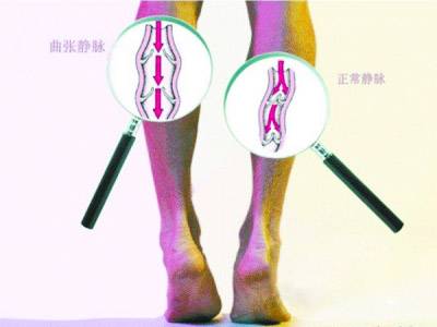 下肢静脉曲张的消除方法?这些方法便能“抚平”哈尔滨治疗静脉曲张
