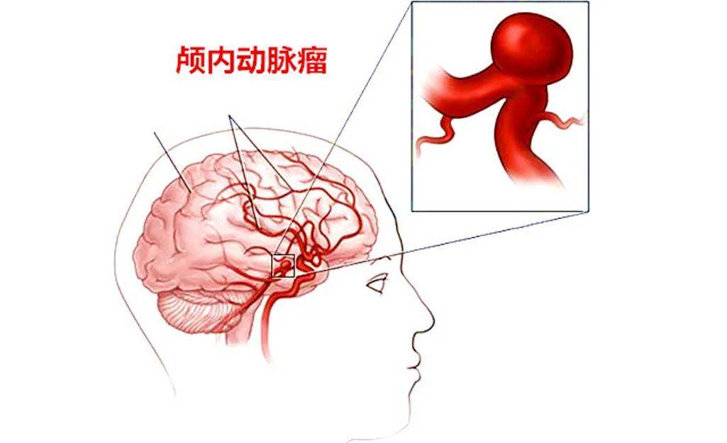 垂体瘤的症状都有哪些症状哈尔滨治疗脑垂体瘤医院好