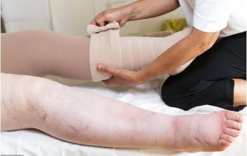 腿浮肿是怎么回事有哪些原因引起的？哈尔滨治疗静脉血栓哪家医院好