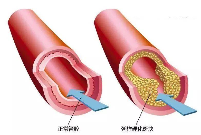 下肢动脉有斑块怎么治疗比较好?哈尔滨下肢动脉斑块医院排名