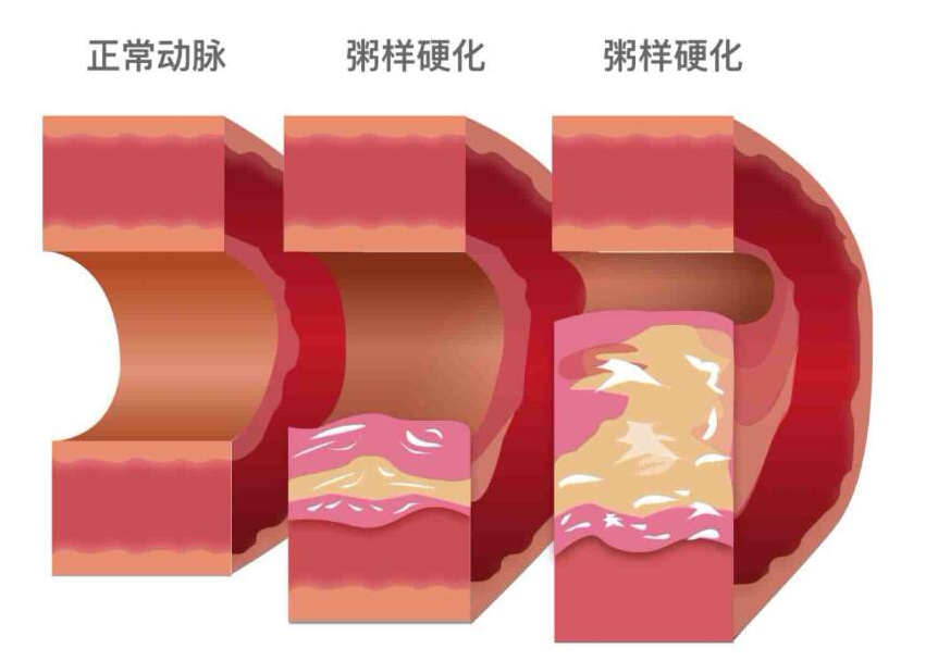 血管狭窄是什么原因引起的？哈尔滨下肢动脉闭塞医院排名