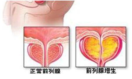 哈尔滨哪个医院看前列腺肥大效果好