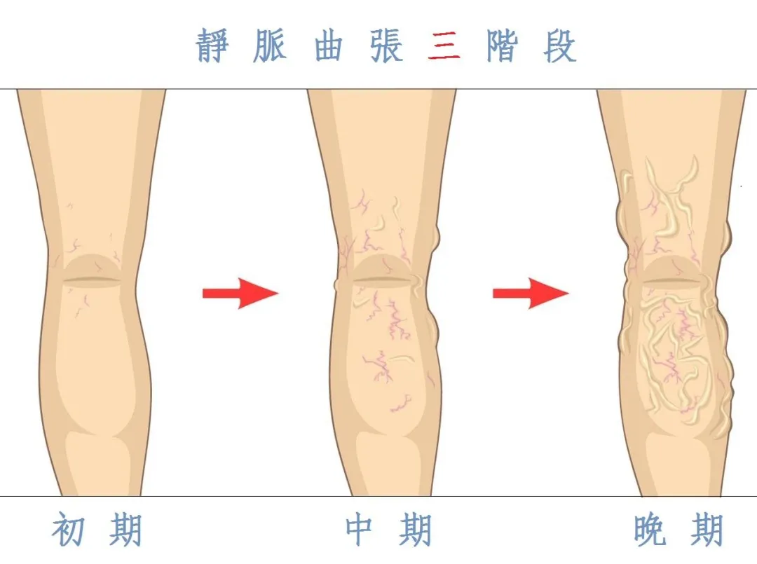 一个腿浮肿是什么原因引起的？你要多注意哈尔滨静脉曲张专科医院