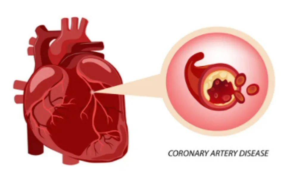 心肌缺血是什么原因造成的哈尔滨心脏病医院