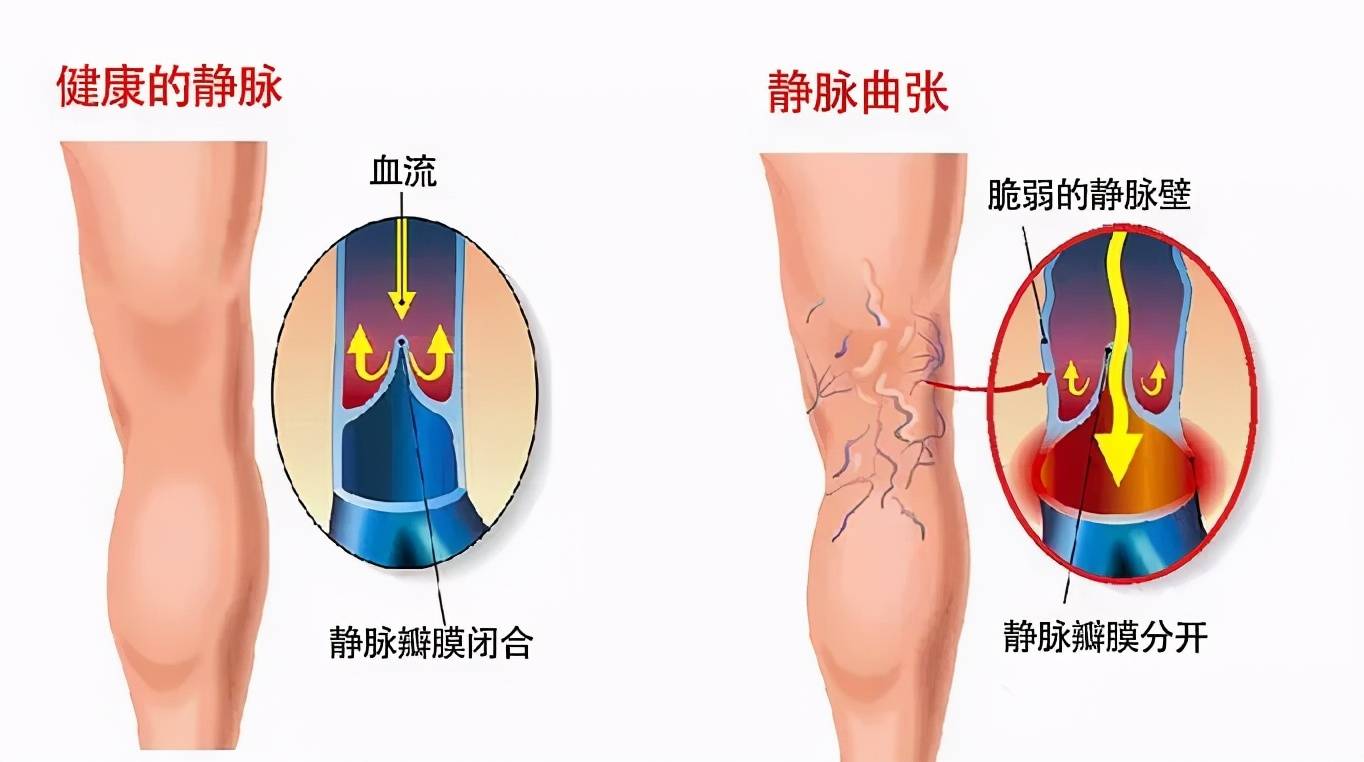 静脉曲张的早期表现？危害有多大哈尔滨能治静脉曲张