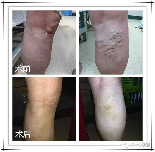 静脉曲张的具体症状？这些你都知道吗哈尔滨静脉曲张医院