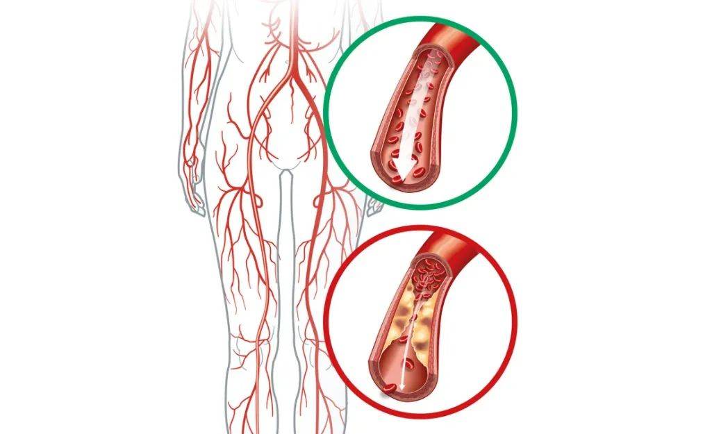 下肢静脉血栓症状图片哈尔滨治疗静脉血栓形成的后遗症