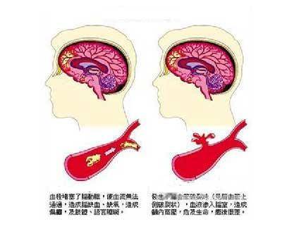 脑血管脑卒中病的诱因哈尔滨治疗脑血管的专科医院