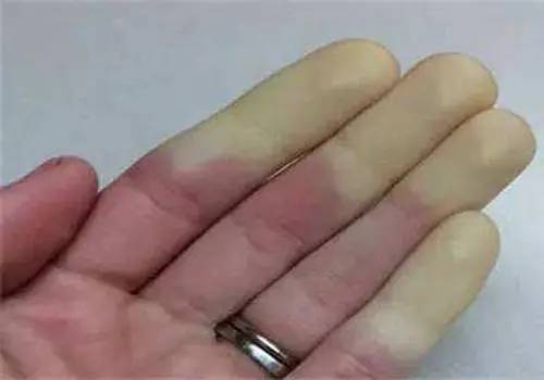 雷诺氏症是什么病?哈尔滨雷诺氏病医院