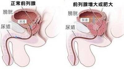 哈尔滨哪个医院治疗前列增生效果好