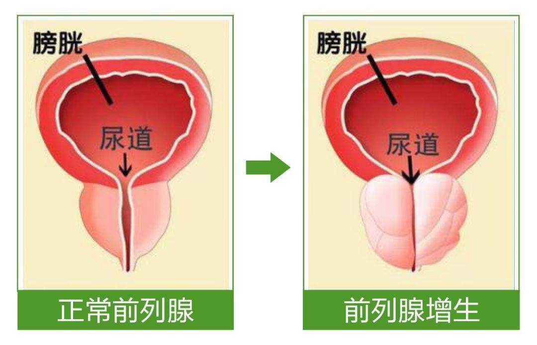 前列腺增生微创手术有哪些技术?现在去医大二院看病需要什么手续