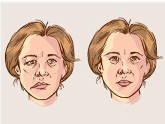 面部神经麻痹的表现有哪些哈尔滨看面神经麻痹的医院