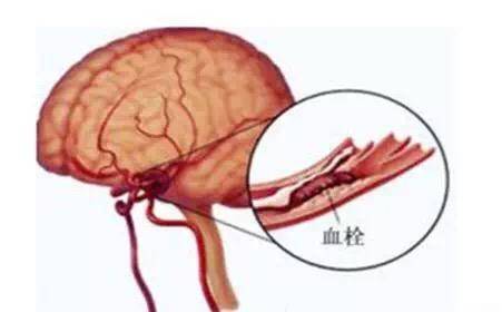 哈尔滨哪治疗脑动脉硬化医院