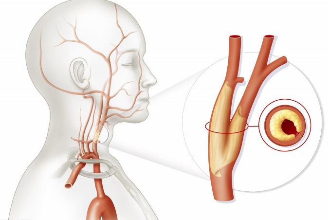 颈部斑块是怎么回事？哈尔滨颈动脉斑块医院排名