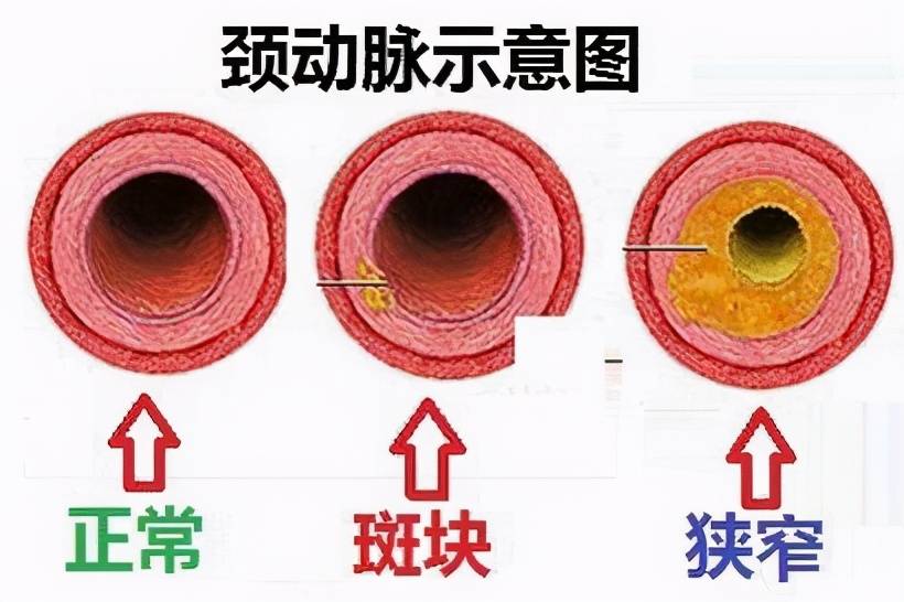 颈动脉斑块怎么治疗？这些应对方法，可逐一尝试哈尔滨脑血栓康复医院