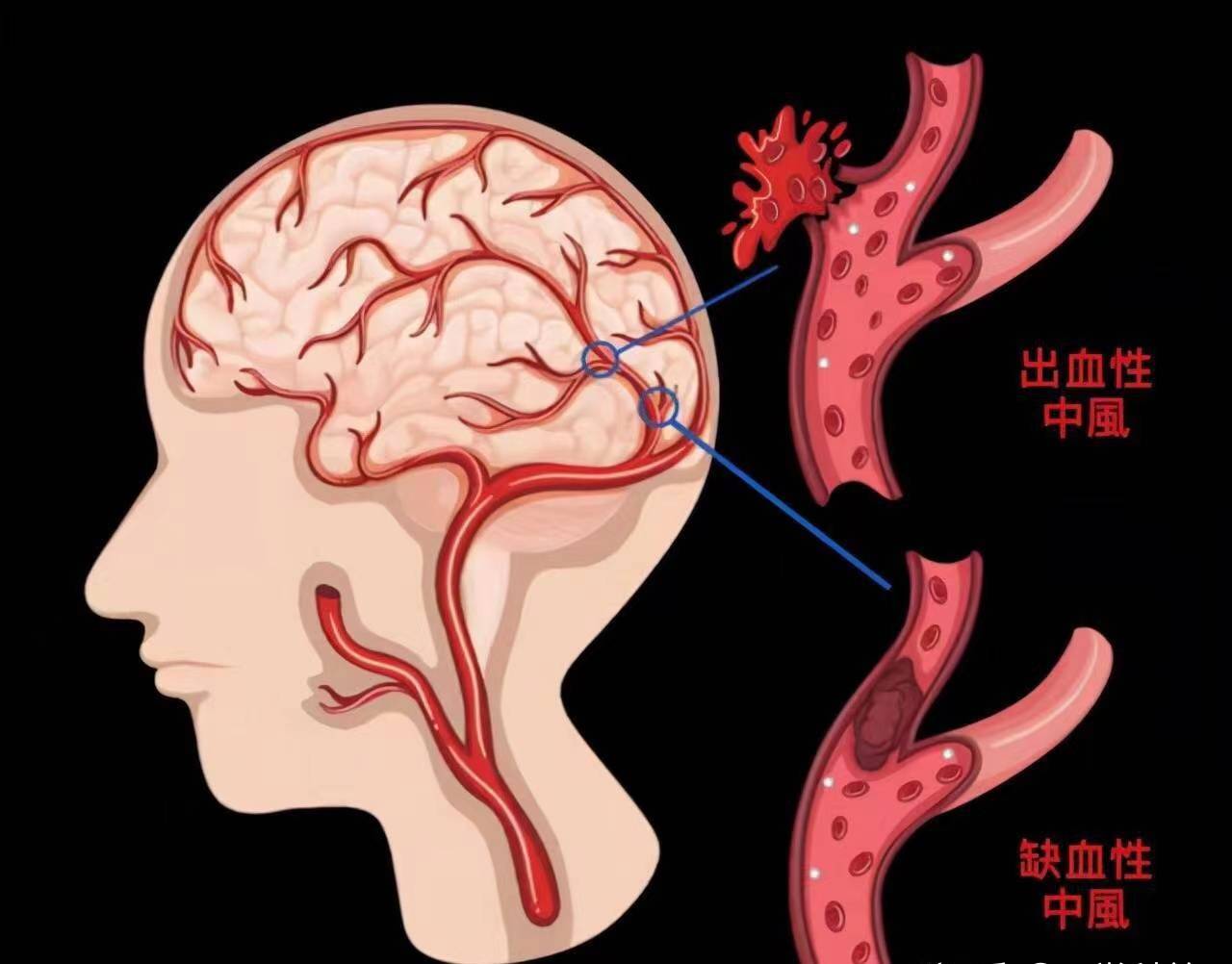 脑供血不足的人，脸上如果不存在这4个信号，那离脑梗很远脑供血不足