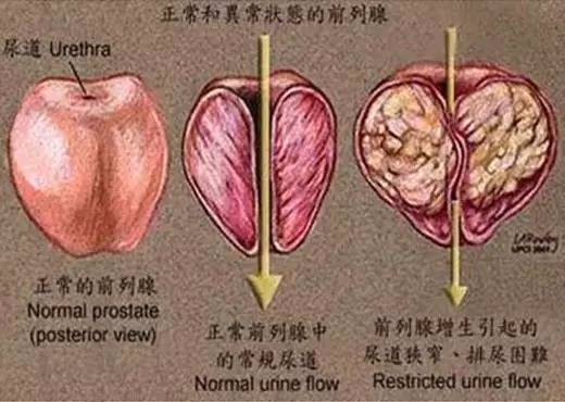 前列腺肥大增生怎么治疗效果最佳哈尔滨前列腺肥大哪里看的好