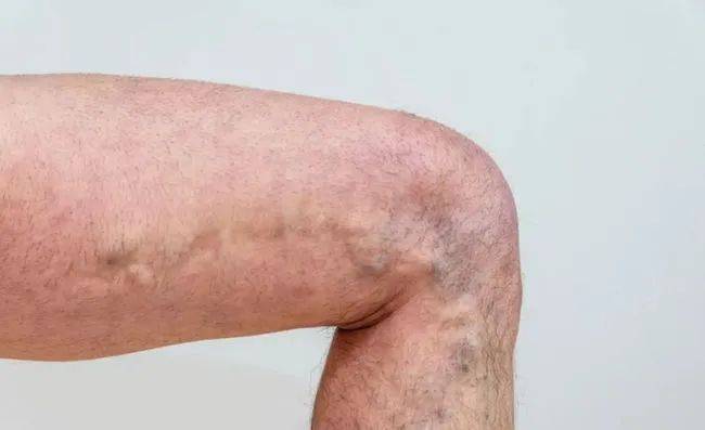 大腿水肿是什么原因引起的？说明了什么问题？糖尿病足哈尔滨