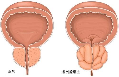 哈尔滨做前列腺手术医院哪好